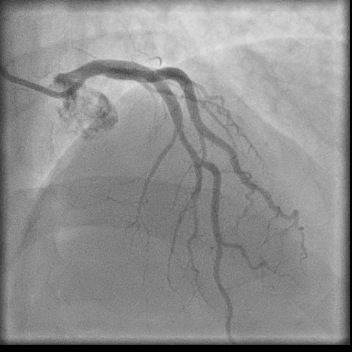 Normal coronary angiogram (DSA) (Radiopaedia 63081-71571 E 38).jpg