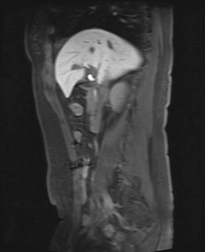 File:Normal hepatobiliary phase liver MRI (Radiopaedia 58968-66230 C 31).jpg