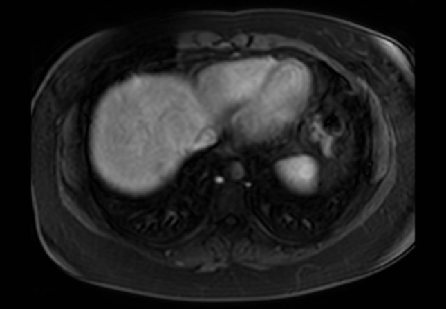 Normal liver MRI with Gadolinium (Radiopaedia 58913-66163 J 69).jpg