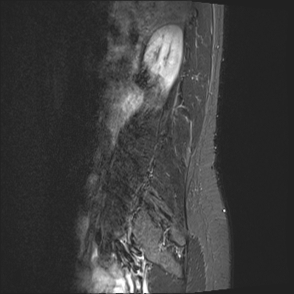 File:Normal lumbar spine MRI- 3 T (Radiopaedia 53280-59250 Sagittal STIR 2).jpg