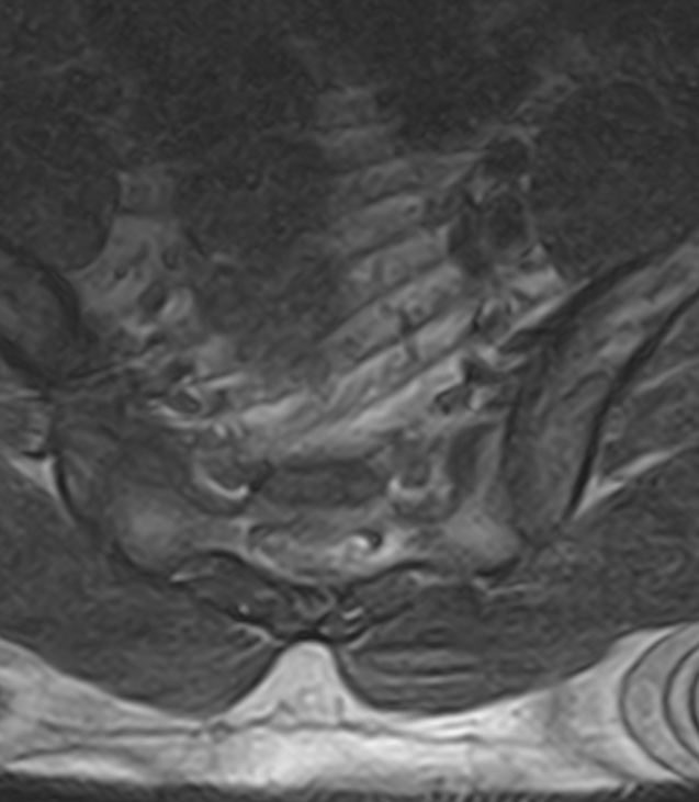 Normal lumbar spine MRI - low-field MRI scanner (Radiopaedia 40976-43699 Axial T2 101).jpg