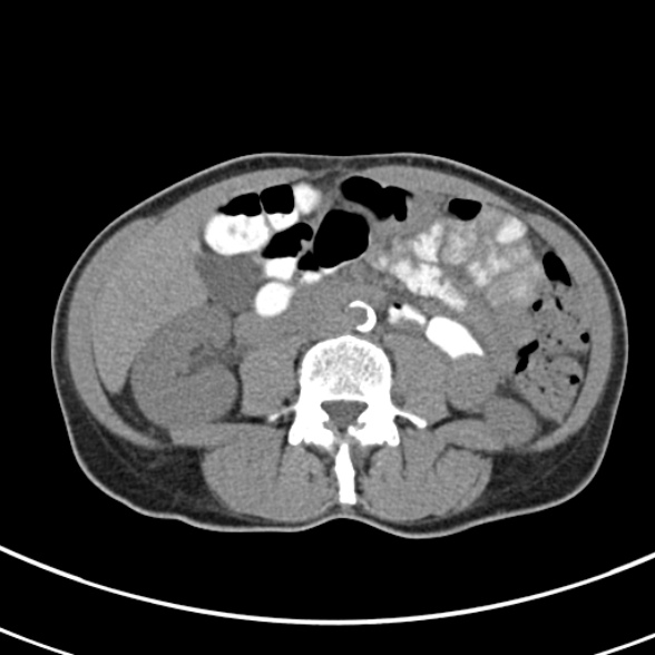 File:Normal multiphase CT liver (Radiopaedia 38026-39996 Axial non-contrast 43).jpg