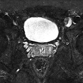 File:Normal prostate (MRI) (Radiopaedia 29986-30535 Axial STIR 12).jpg