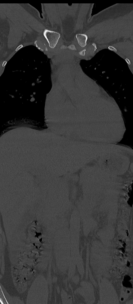 Normal thoracolumbar spine (Radiopaedia 43822-47309 Coronal bone window 15).png