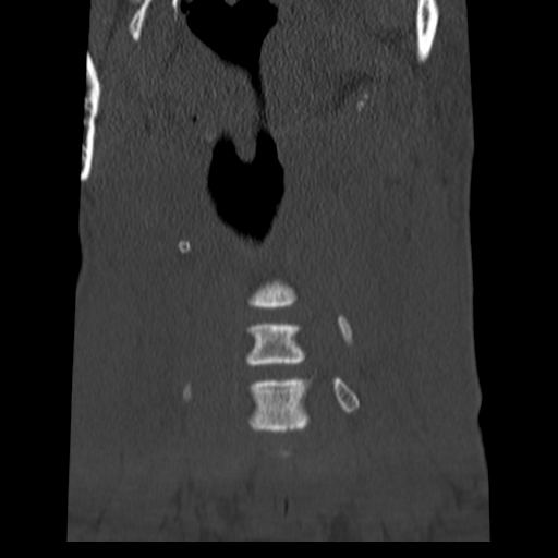 File:Normal trauma cervical spine (Radiopaedia 41017-43760 Coronal bone window 4).png