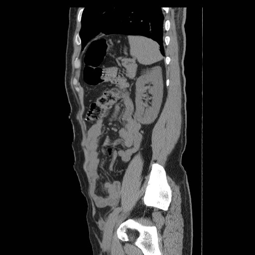 File:Obstructed kidney with perinephric urinoma (Radiopaedia 26889-27066 B 50).jpg