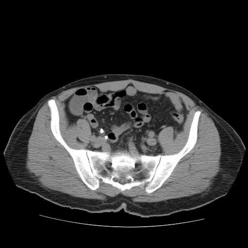 File:Obstructed kidney with perinephric urinoma (Radiopaedia 26889-27067 Axial non-contrast 40).jpg
