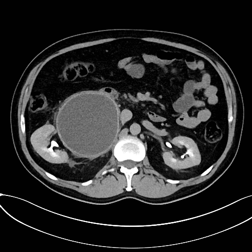 Obstructed upper pole ureter in a duplex kidney (Radiopaedia 54935-61221 Axial C+ delayed 20).jpg