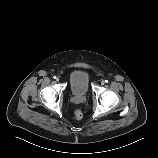 Obstructing sigmoid adenocarcinoma (Radiopaedia 58465-65619 A 154).jpg