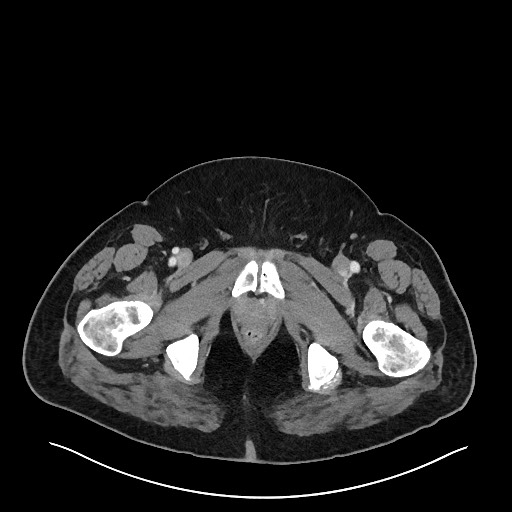 File:Obstructing sigmoid adenocarcinoma (Radiopaedia 58465-65619 A 167).jpg