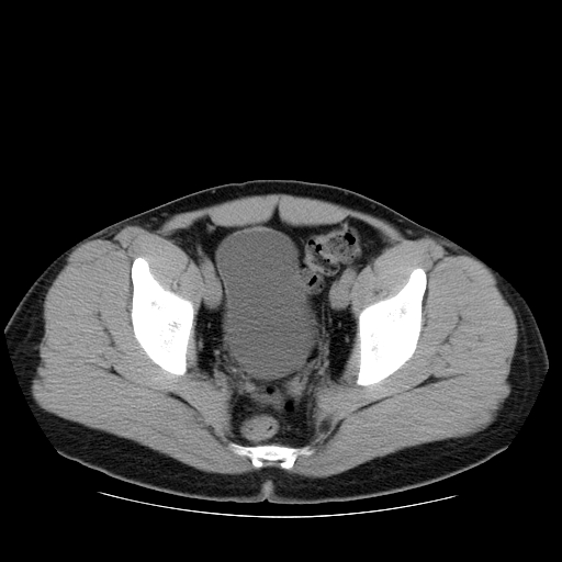 File:Obstructing ureteric calculus (Radiopaedia 18615-18514 Axial non-contrast 49).jpg