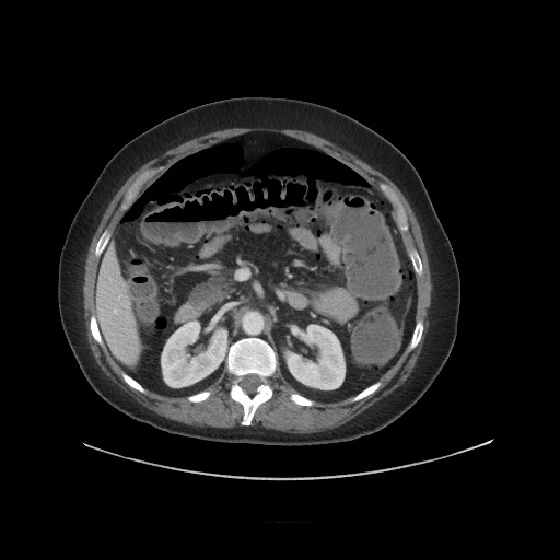 Obstructive distal colonic adenocarcinoma causing cecal perforation (Radiopaedia 86830-102989 A 75).jpg