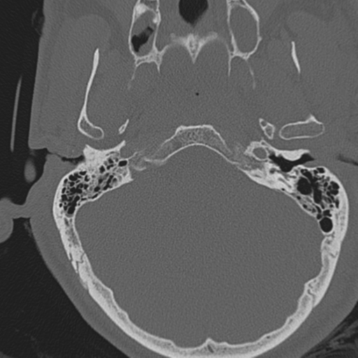File:Occipital condyle fracture (Radiopaedia 33467-34517 Axial bone window 6).png