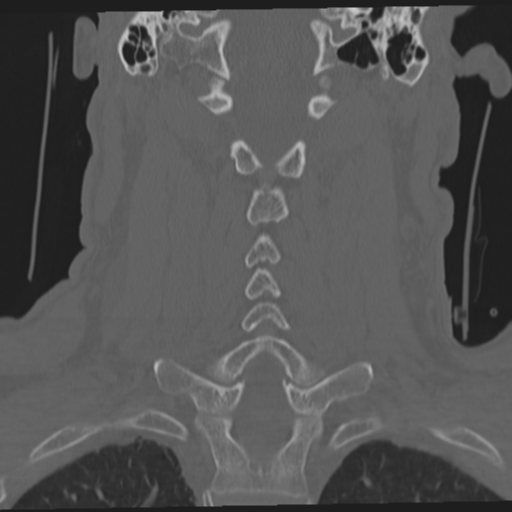 File:Occipital condyle fracture (Radiopaedia 33467-34517 Coronal bone window 41).png