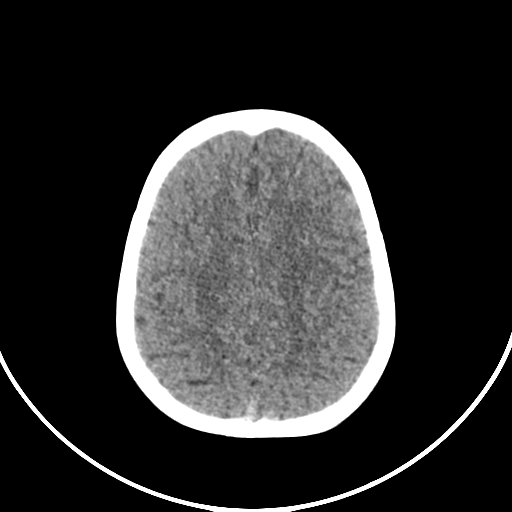 Occipital encephalocele (Radiopaedia 87339-103636 Axial non-contrast 65).jpg
