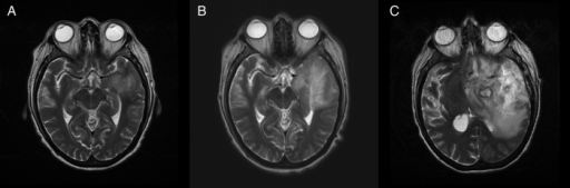 Image of granulomatous amoebic encephalitis caused by Acanthamoeba