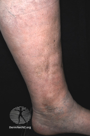 File:Pretibial myxoedema in Graves disease (DermNet NZ dermal-infiltrative-pretibial-myxoedema-13).jpg