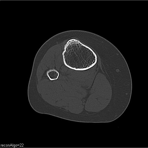 File:ACL avulsion fracture (Radiopaedia 33833-34994 Axial bone window 25).jpg