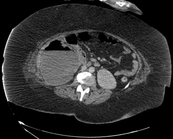 File:Abdominal abscess - pre and post percutaneous drainage (Radiopaedia 60209-67816 Axial 11).png