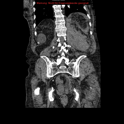 File:Abdominal aortic aneurysm- extremely large, ruptured (Radiopaedia 19882-19921 Coronal C+ arterial phase 79).jpg