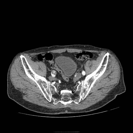 Abdominal aortic aneurysm (Radiopaedia 13341-13340 Axial C+ arterial phase 205).jpg