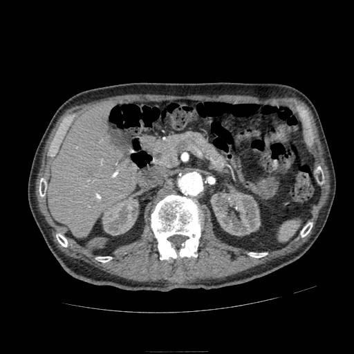 File:Abdominal aortic aneurysm (Radiopaedia 13341-13340 Axial C+ arterial phase 62).jpg
