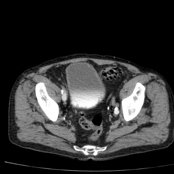 Abdominal aortic aneurysm (Radiopaedia 29248-29660 Axial C+ arterial phase 77).jpg