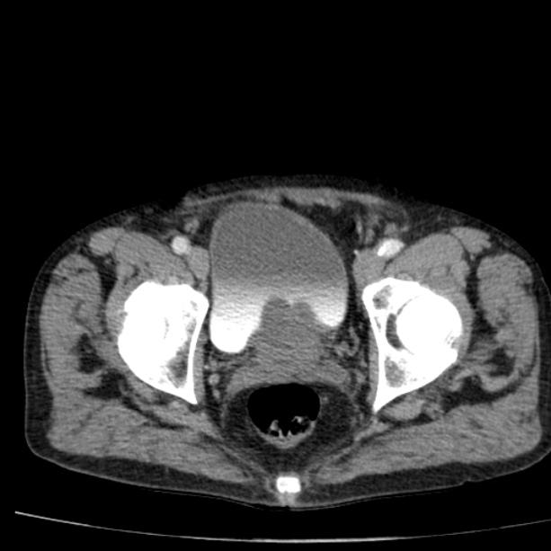 Abdominal aortic aneurysm (Radiopaedia 29248-29660 Axial C+ arterial phase 84).jpg