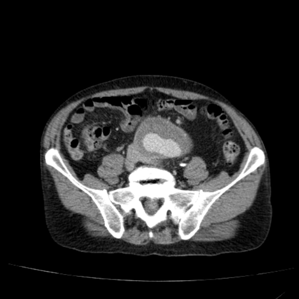 Abdominal aortic aneurysm (Radiopaedia 29248-29660 Axial C+ portal venous phase 43).jpg