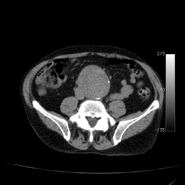 Abdominal aortic aneurysm (Radiopaedia 29248-29660 Axial non-contrast 37).jpg