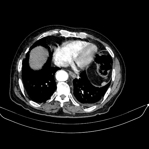 Abdominal aortic aneurysm (Radiopaedia 67117-76452 Axial C+ arterial phase 12).jpg