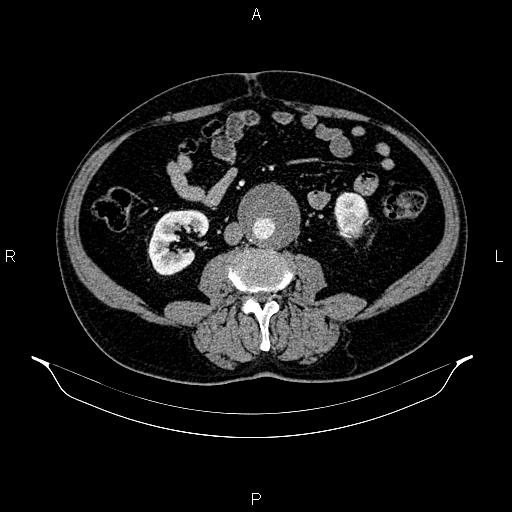Abdominal aortic aneurysm (Radiopaedia 83094-97462 Axial renal cortical phase 106).jpg