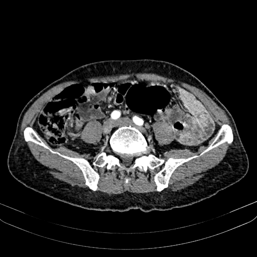 Abdominal aortic aneurysm (Radiopaedia 83581-98689 Axial C+ arterial phase 80).jpg