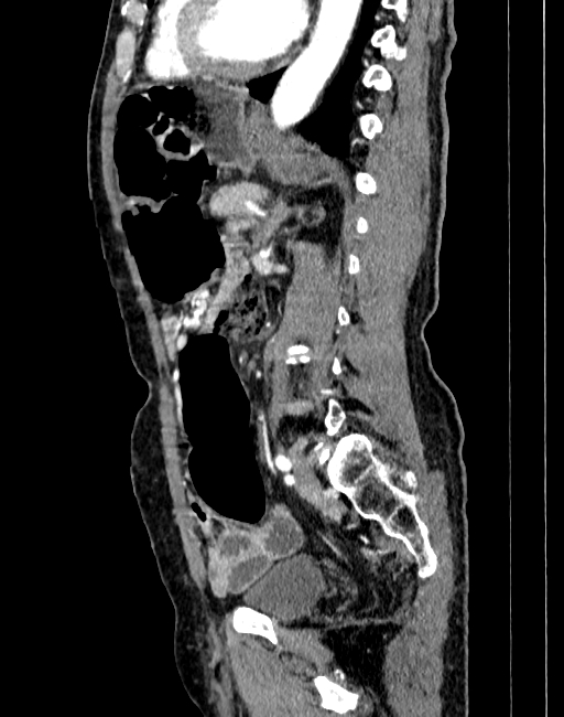 Abdominal aortic aneurysm (Radiopaedia 83581-98689 Sagittal C+ arterial phase 67).jpg