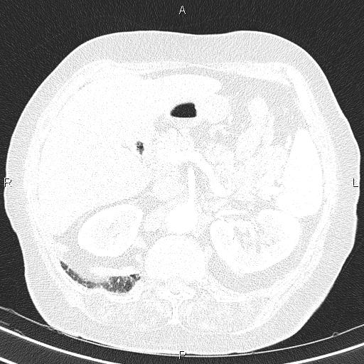 Abdominal aortic aneurysm (Radiopaedia 85063-100606 Axial lung window 66).jpg