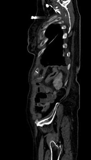 Abdominal aortic aneurysm with thrombus fissuration (Radiopaedia 73192-83919 Sagittal C+ arterial phase 10).jpg