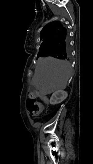 Abdominal aortic aneurysm with thrombus fissuration (Radiopaedia 73192-83919 Sagittal C+ arterial phase 119).jpg