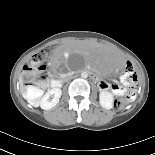 Abdominal desmoid tumor (Radiopaedia 41007-43740 Axial C+ portal venous phase 28).png