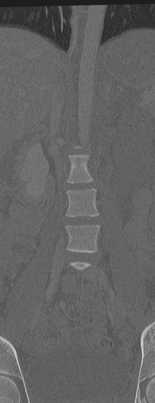 Abdominal multi-trauma - devascularised kidney and liver, spleen and pancreatic lacerations (Radiopaedia 34984-36486 Coronal bone window 17).png