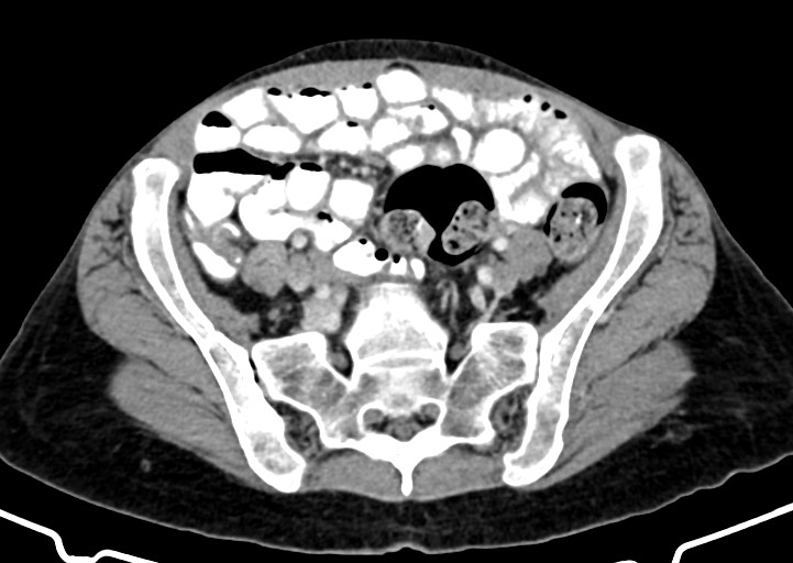 Abdominal wall and retroperitoneal tuberculosis (Radiopaedia 88137-104729 Axial C+ portal venous phase 140).jpg