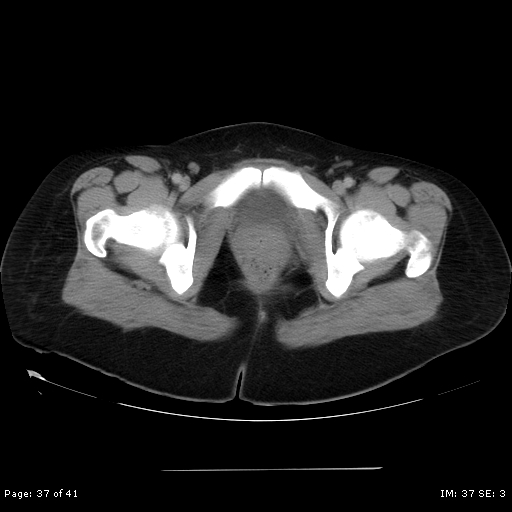File:Abdominal wall endometriosis (Radiopaedia 25723-25885 Axial C+ portal venous phase 37).jpg