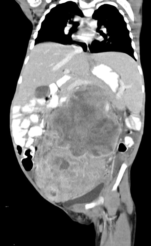 Abdominopelvic rhabdomyosarcoma (Radiopaedia 78356-90984 Coronal C+ portal venous phase 48).jpg
