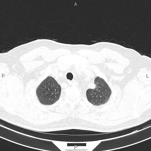Aberrant right subclavian artery (Radiopaedia 87093-103354 Axial lung window 16).jpg