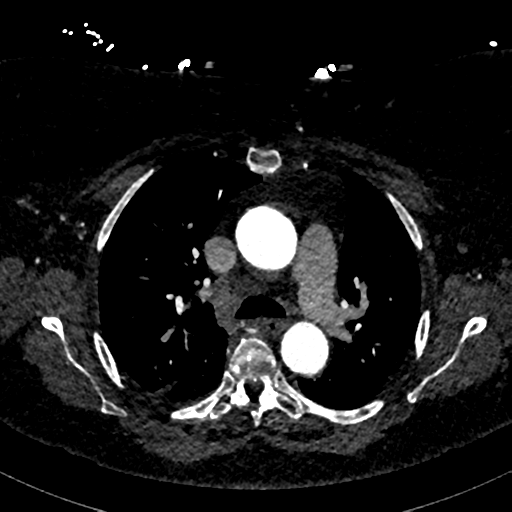 File:Aberrant right subclavian artery with Kommerell diverticulum (Radiopaedia 47982-52769 Axial C+ arterial phase 34).png