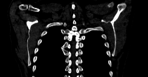 File:Accesory rib joint (Radiopaedia 71987-82452 Coronal bone window 60).jpg