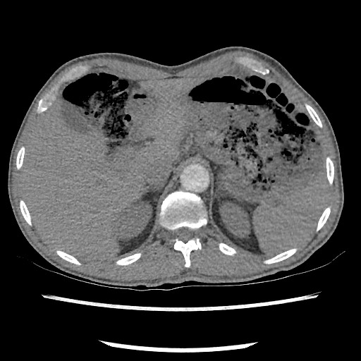 Accessory left horizontal fissure with lingular pneumonia (Radiopaedia 53763-59843 Axial C+ CTPA 88).jpg