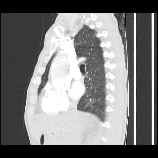 Accessory left horizontal fissure with lingular pneumonia (Radiopaedia 53763-59843 Sagittal lung window 31).jpg