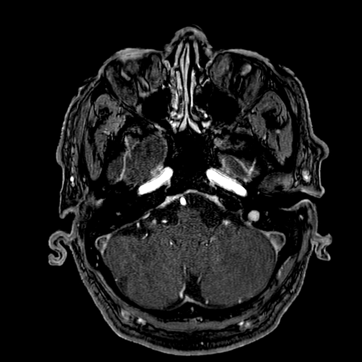 Accessory middle cerebral artery (Radiopaedia 73114-83828 Axial MRA 28).jpg