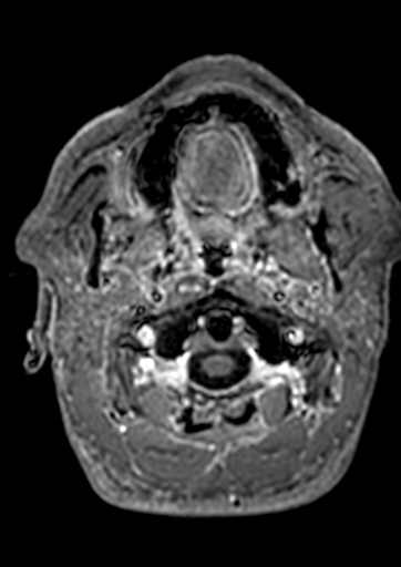 File:Accessory middle cerebral artery (Radiopaedia 73114-83828 Axial T1 C+ 212).jpg