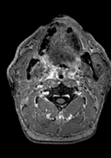Accessory middle cerebral artery (Radiopaedia 73114-83828 Axial T1 C+ 255).jpg